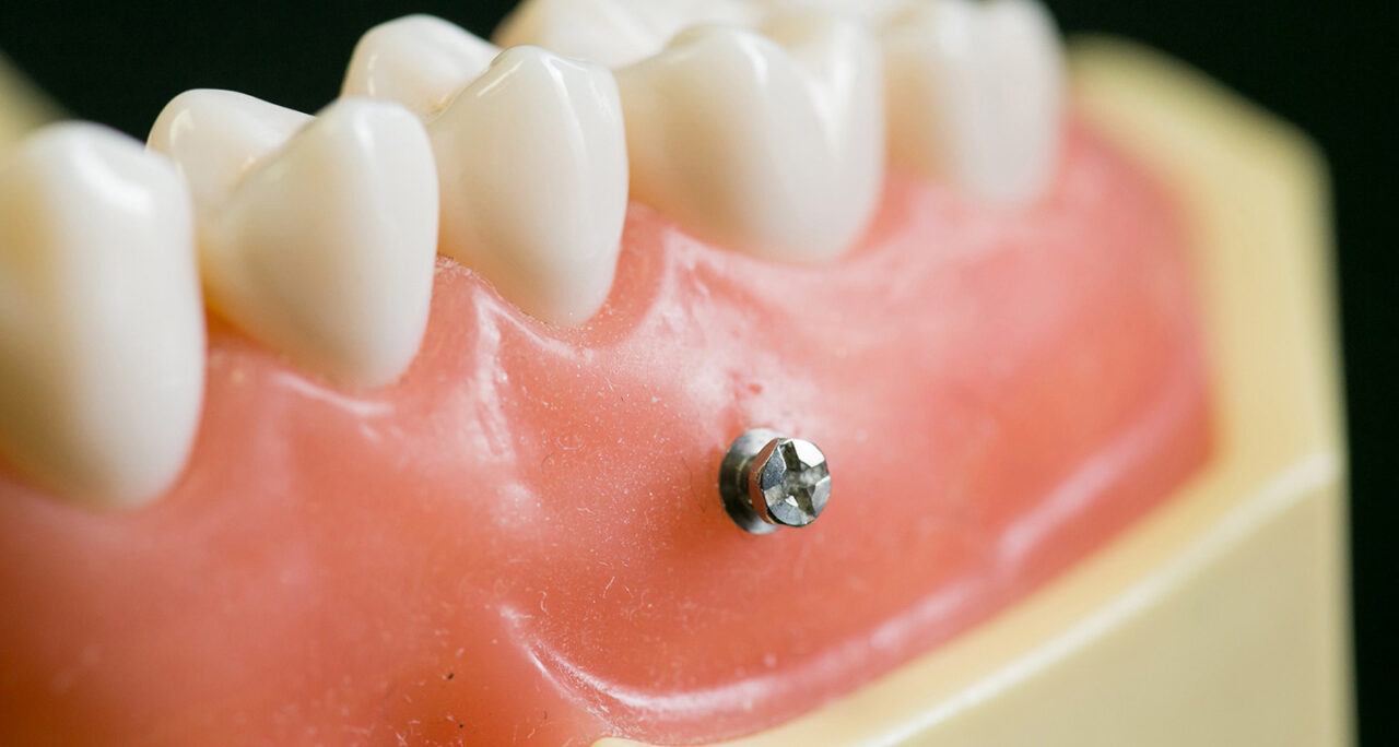 インプラントアンカー